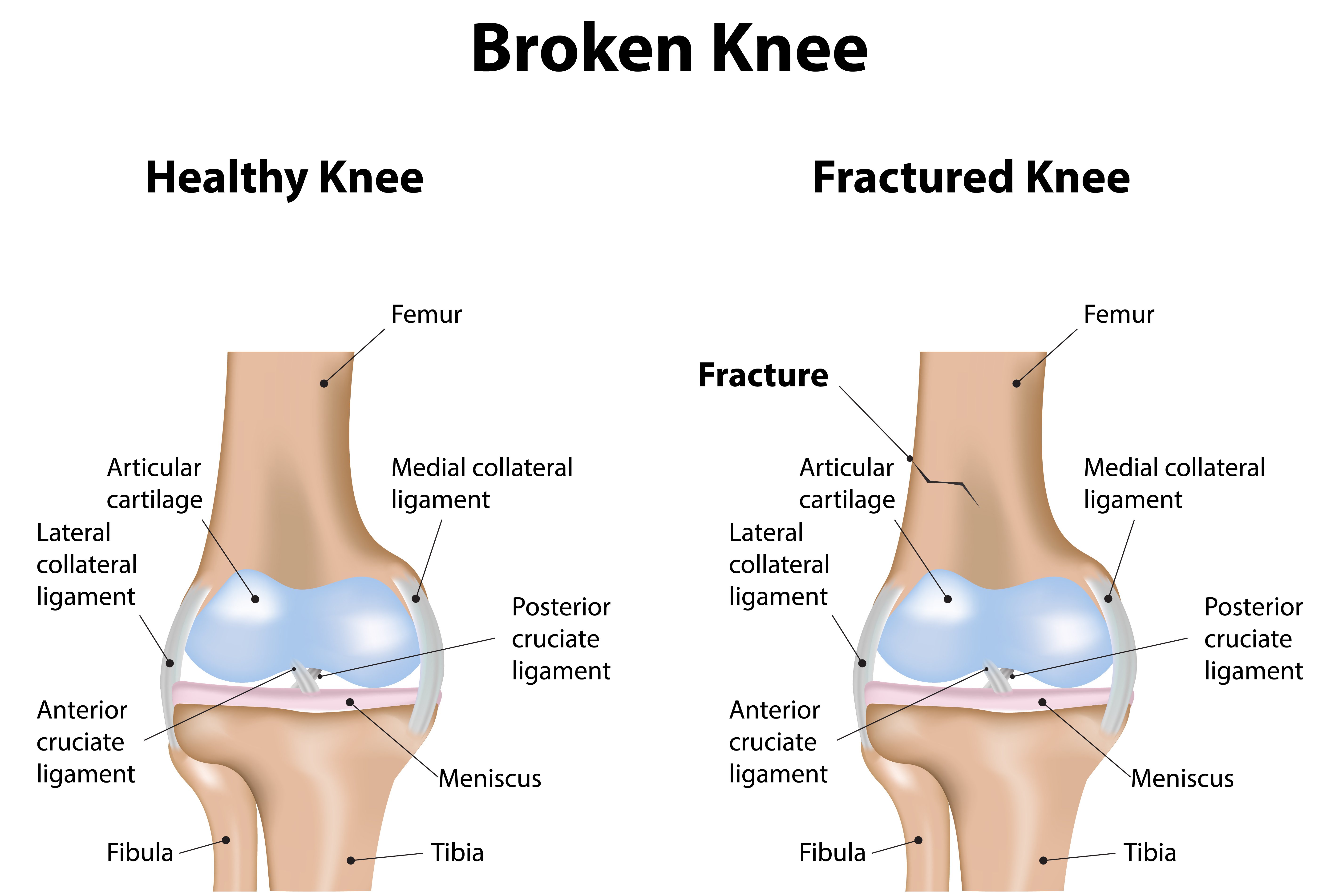 knee fracture